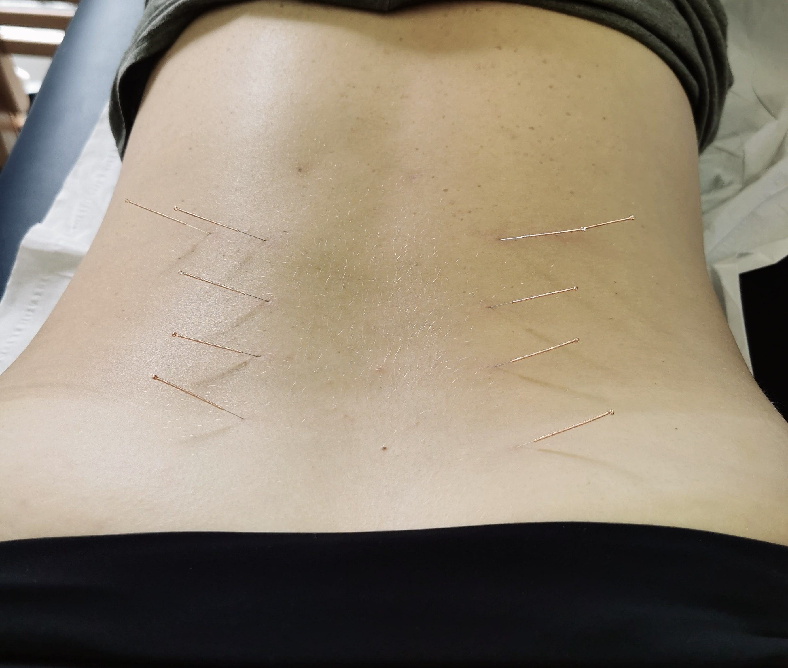 Dry Needling in the lower back of a client