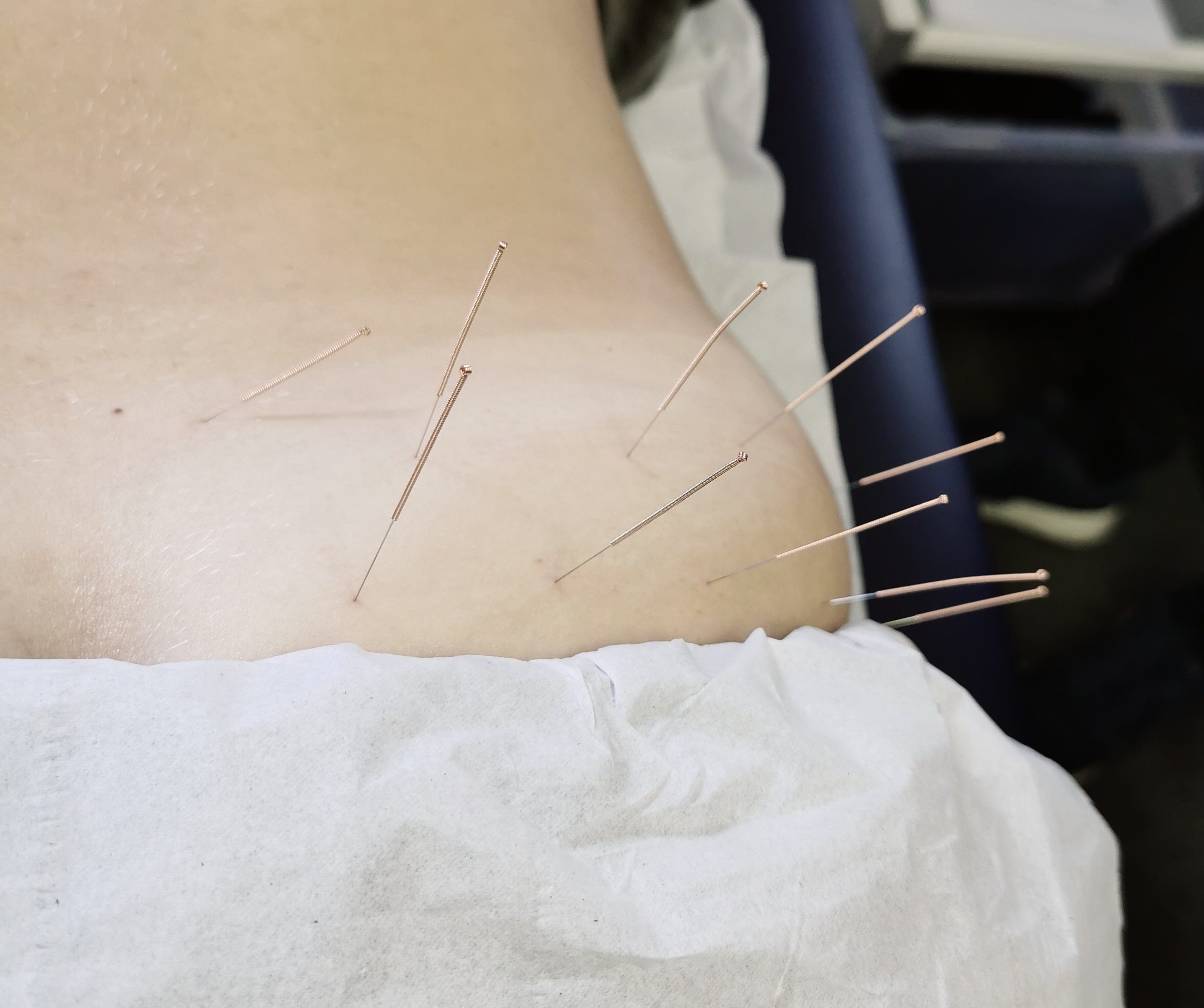 Dry needling to the glutes