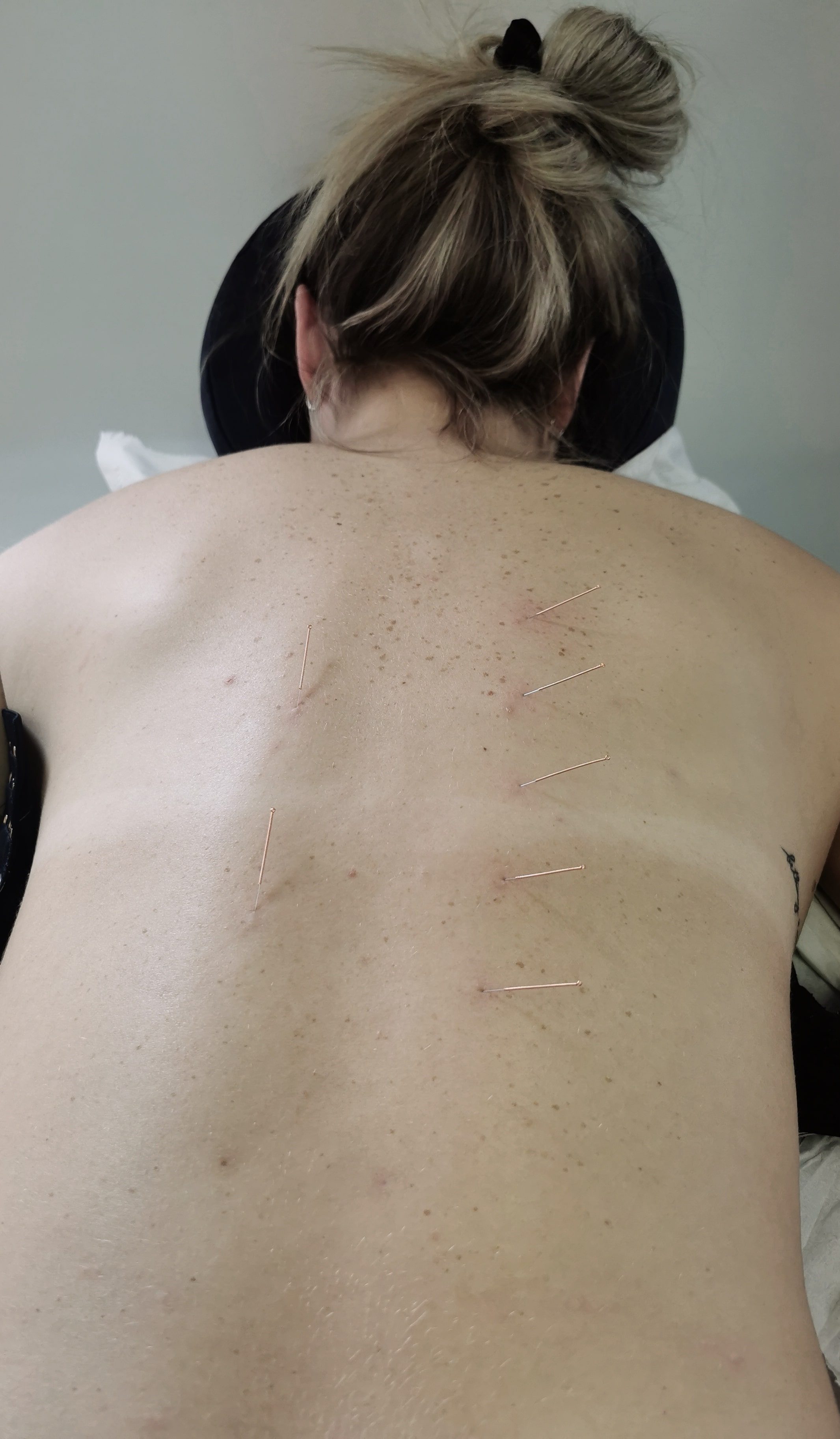 Dry needling to the clients back