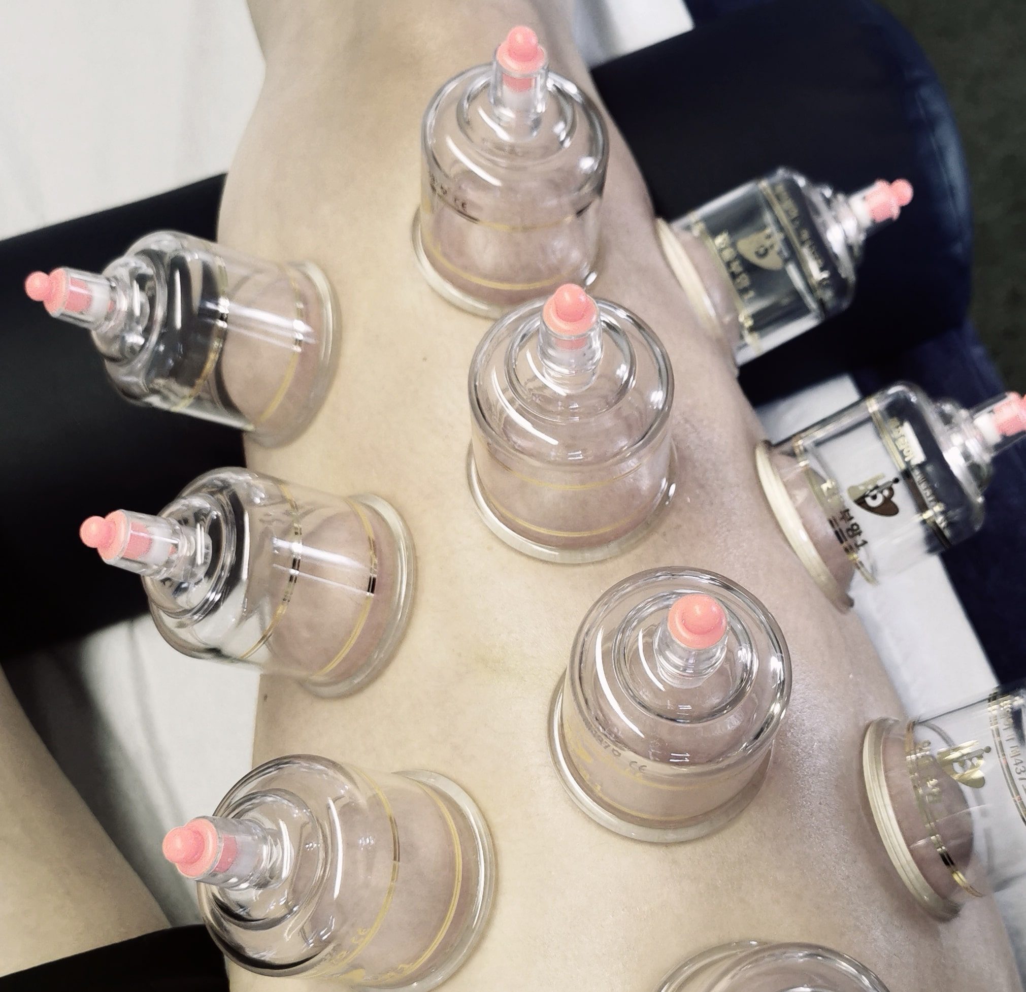 Dry Cupping being carried out on a quadricep
