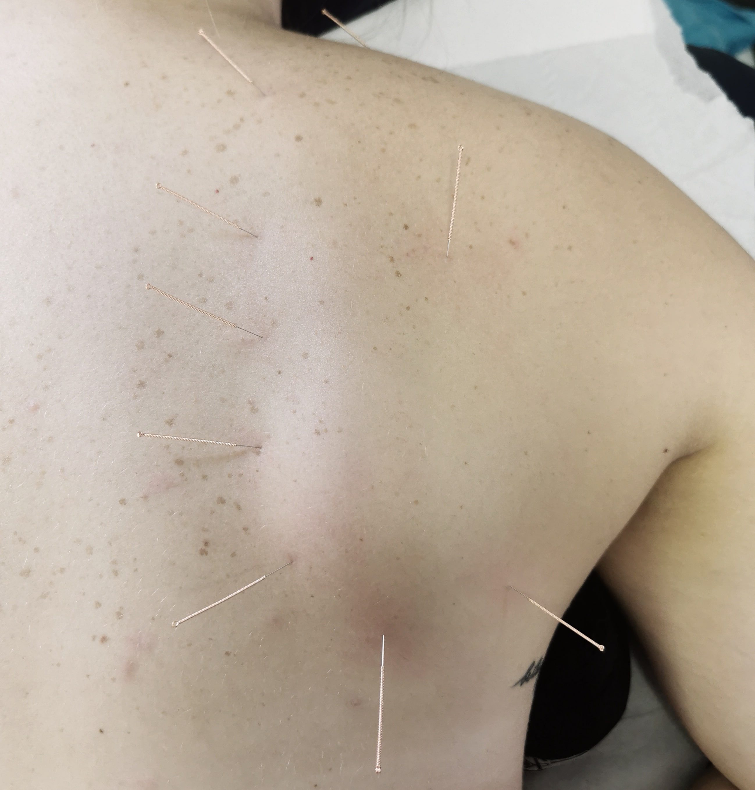 Dry Needling to the scapula