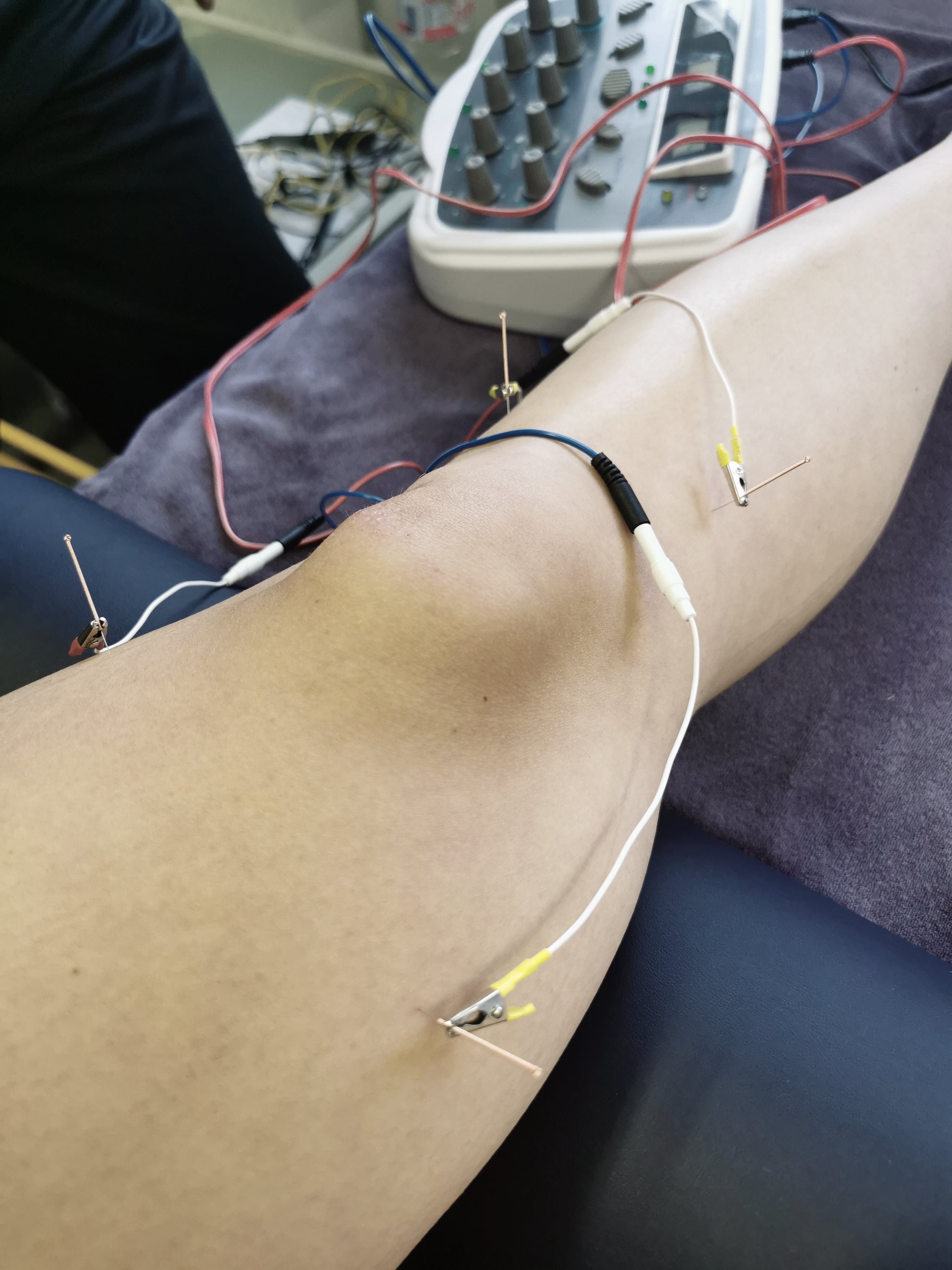 Electro Needling being carried out on the knee