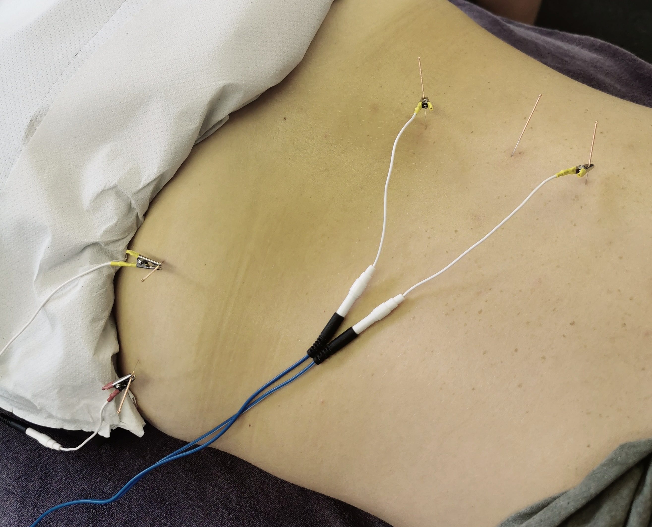 Electro needling to the clients back